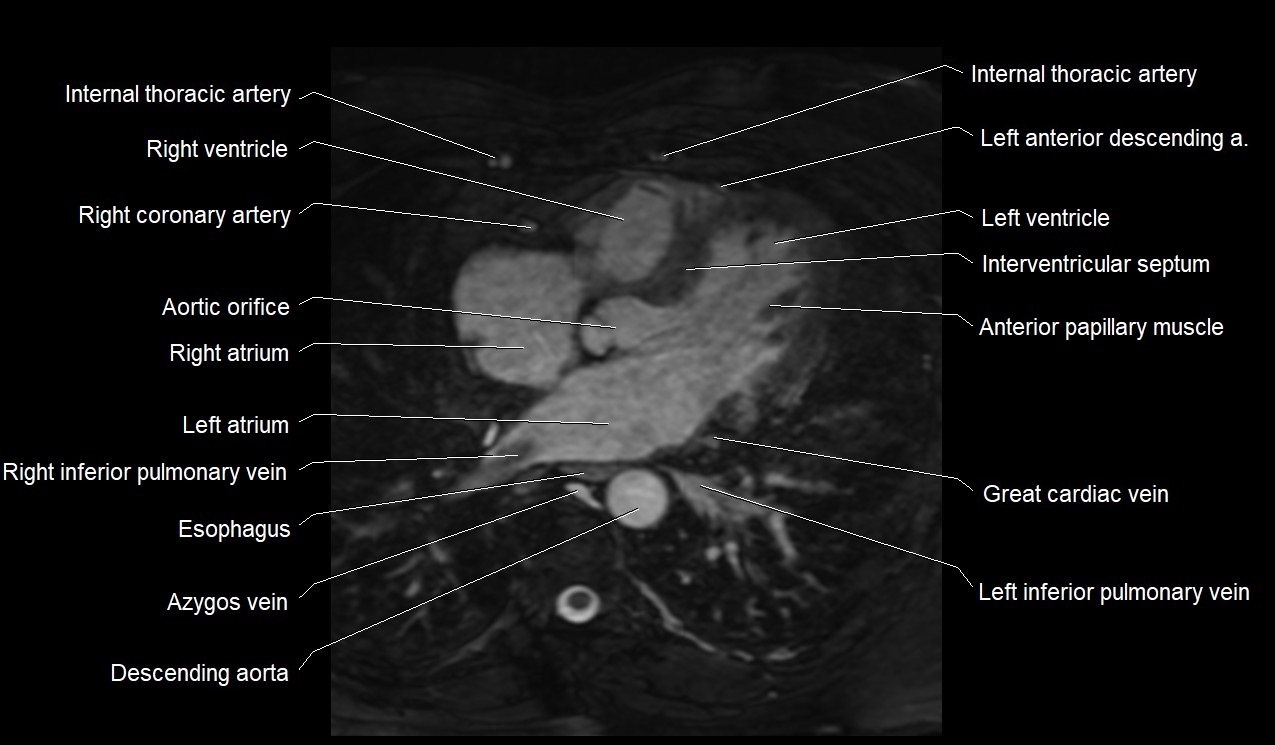 MRI heart coronary arteries and coronary veins anatomy axial image 25.jpg